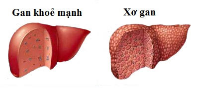 phong-benh-xo-gan